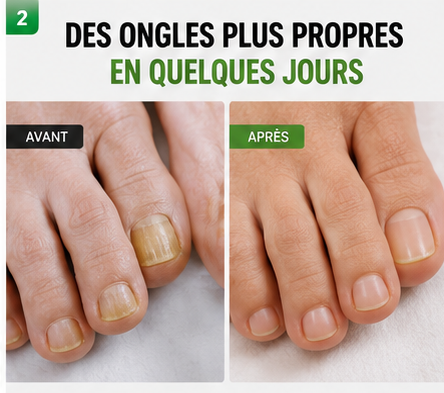 NAILS FUNGUS