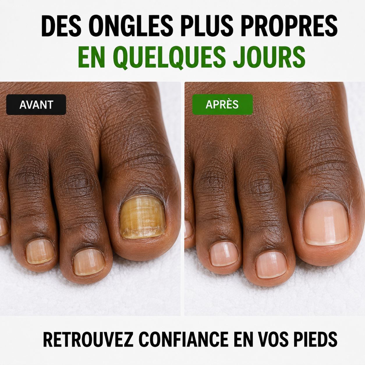 NAILS FUNGUS